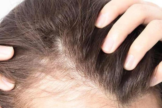 وصفات طبيعية لإنبات فراغات الشعر
